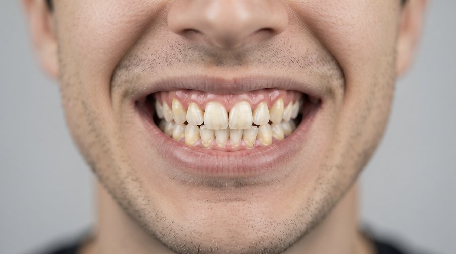 No flossing